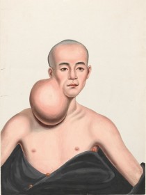 Lam Qua, Retrato médico